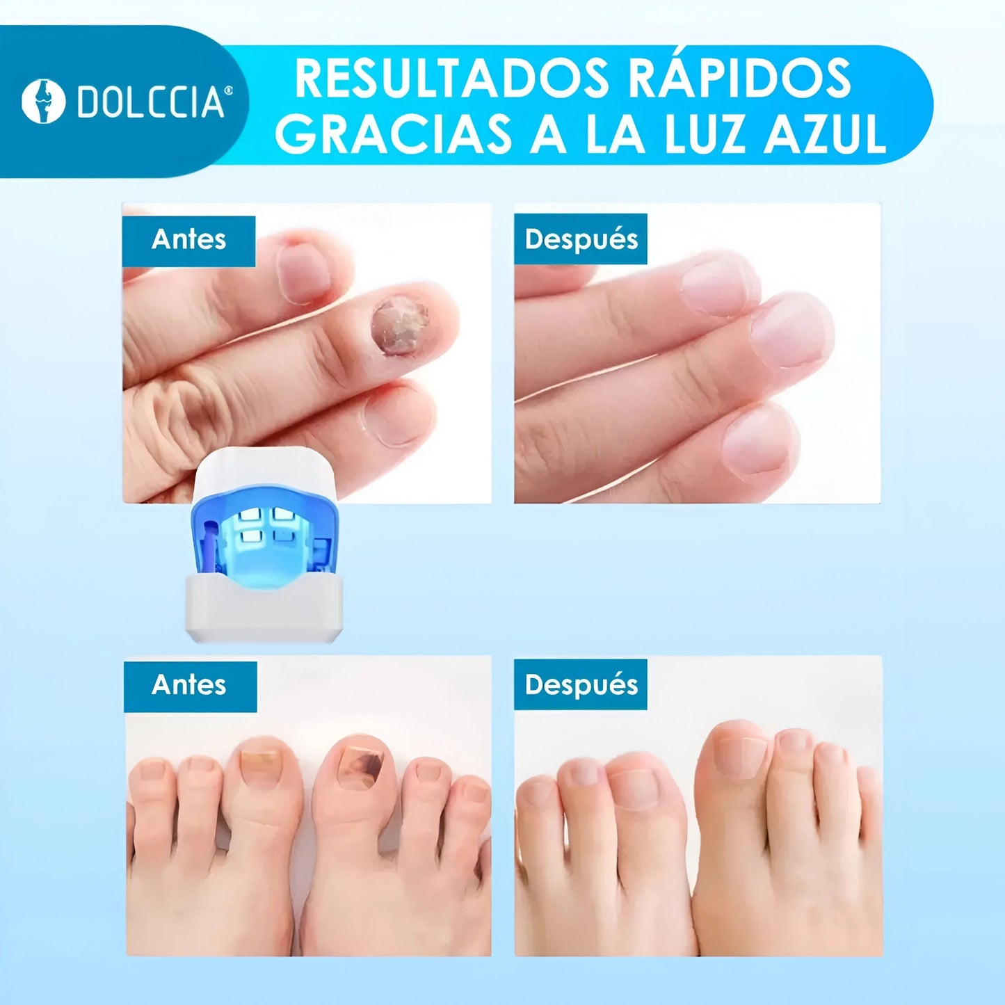 TRATAMIENTO LÁSER EFECTIVO PARA HONGOS EN LAS UÑAS